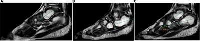 Magnetic Resonance Imaging of Clubfoot Treated With the Ponseti Method: A Short-Term Outcome Study